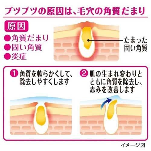 日本KOBAYASHI小林制药 手臂鸡皮角质软化毛囊药膏 30g（保质期：08/28y）